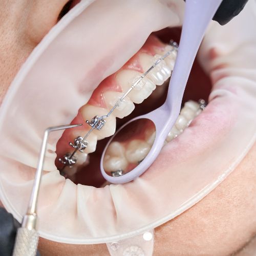 Teeth Straightening