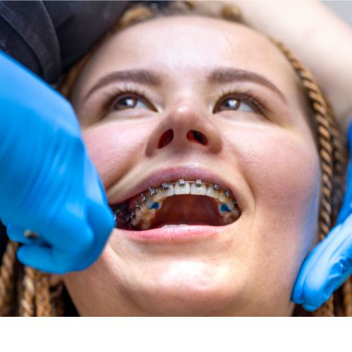 Teeth Straightening
