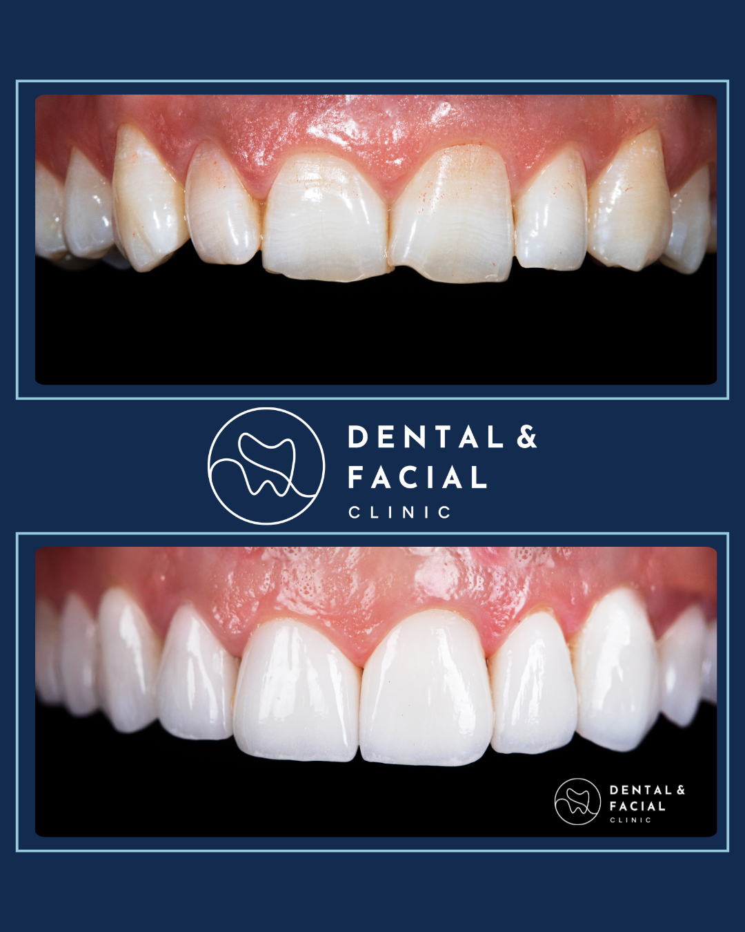 Composite Veneers 19 1