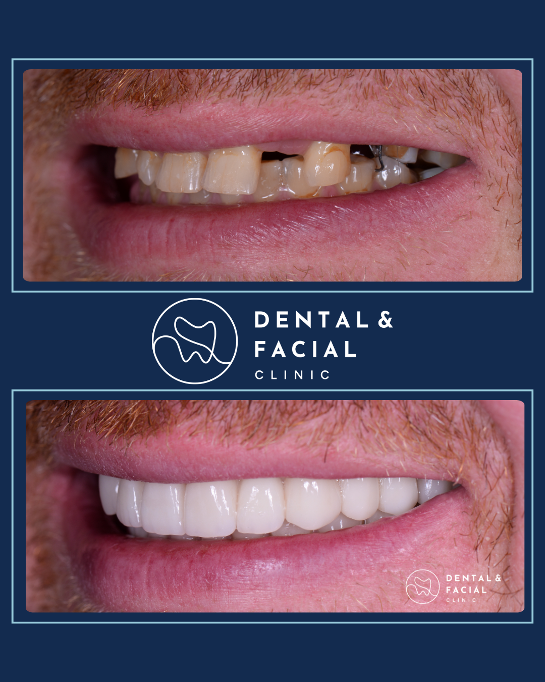 Teeth Implants 19 Treatment: VENEERS + IMPLANTS
Approximate Treatment Time: 5 months