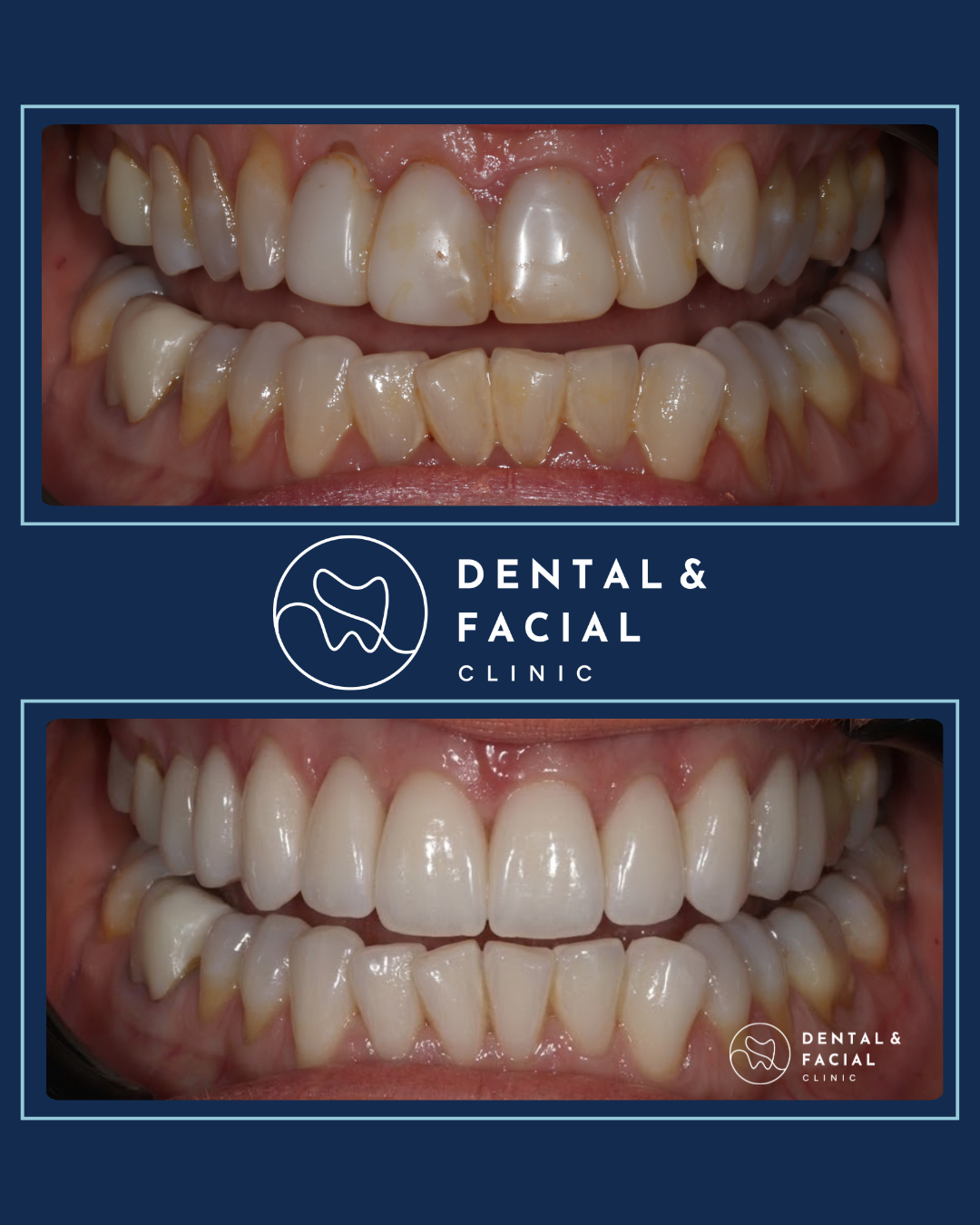 Composite Veneers 27 10