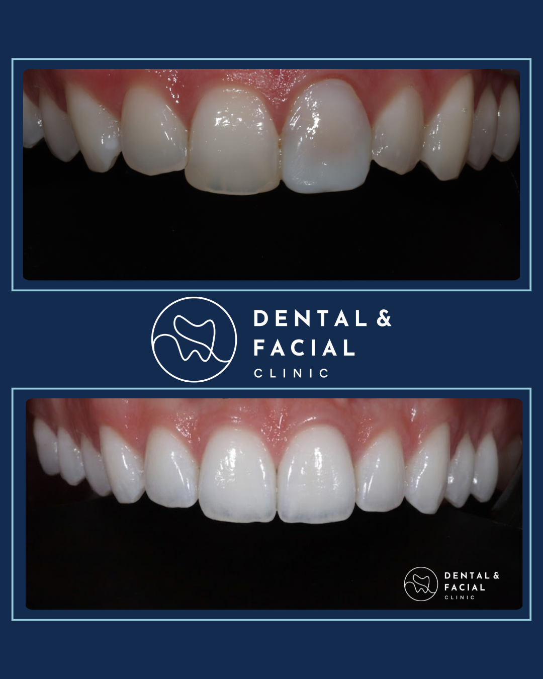 Composite Veneers 28 11