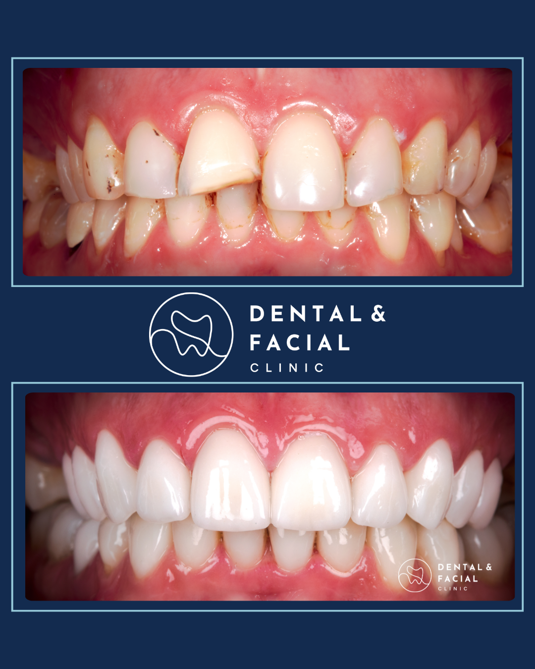 Composite Veneers 20 2
