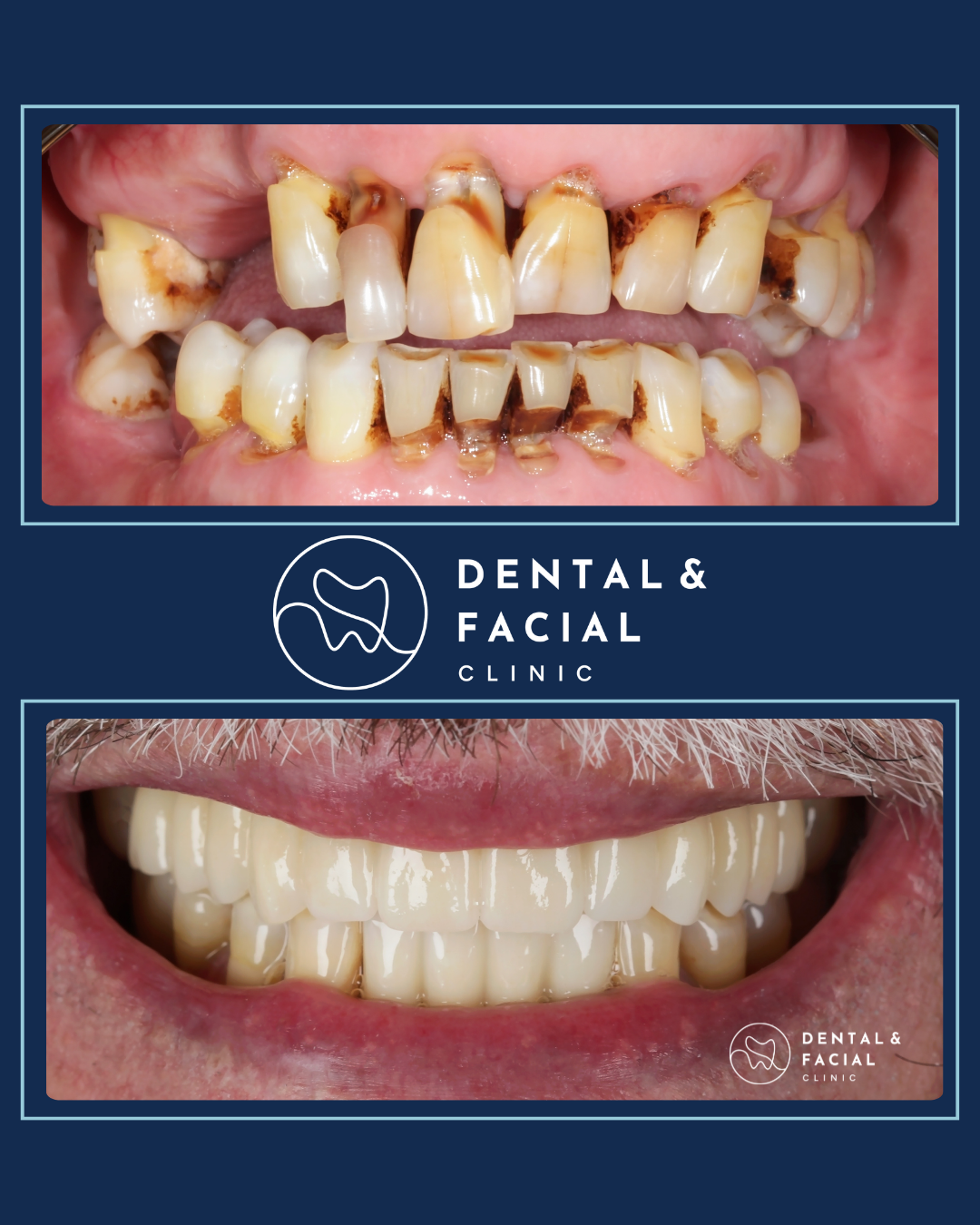 Teeth Implants 20 2