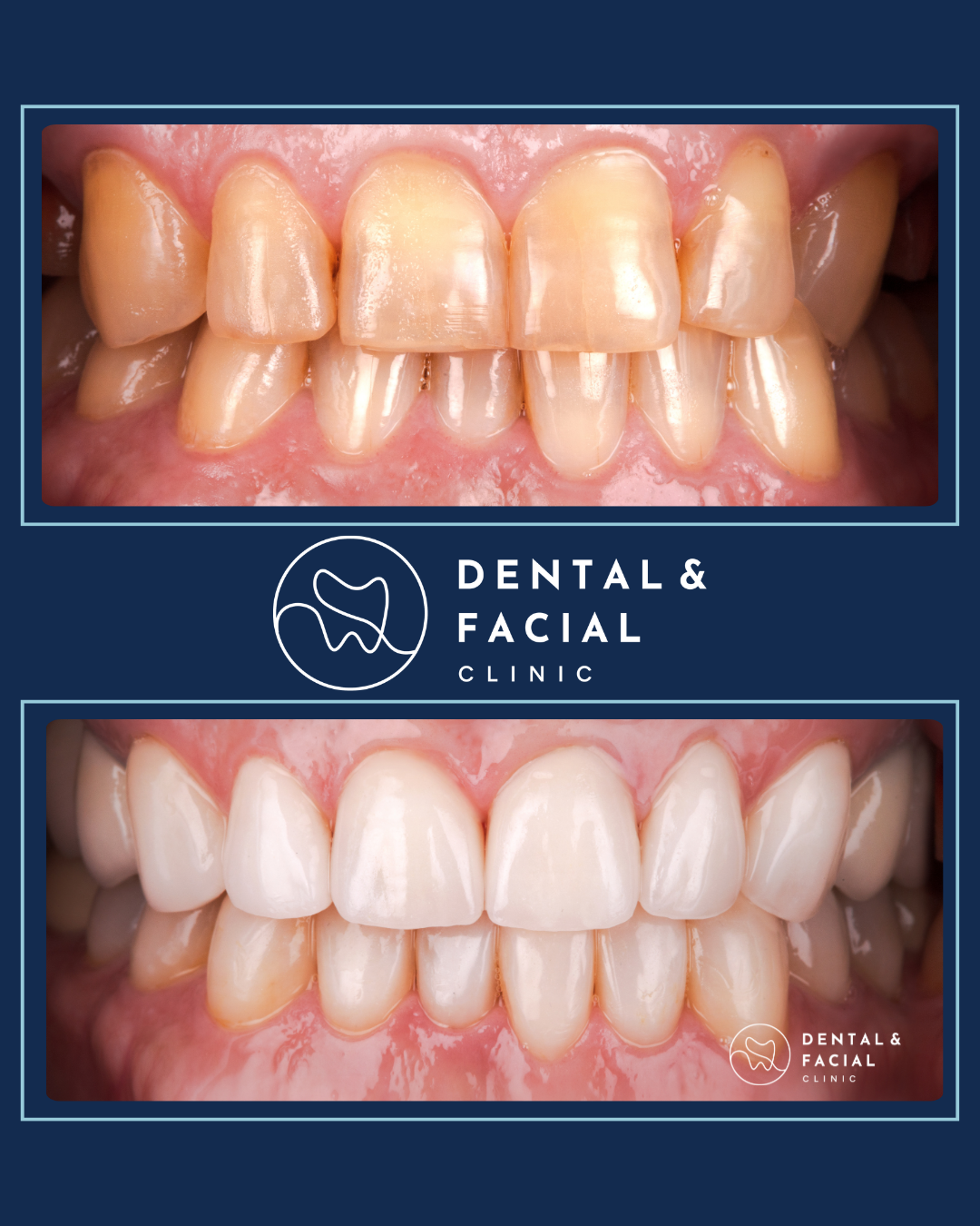 Composite Veneers 21 3