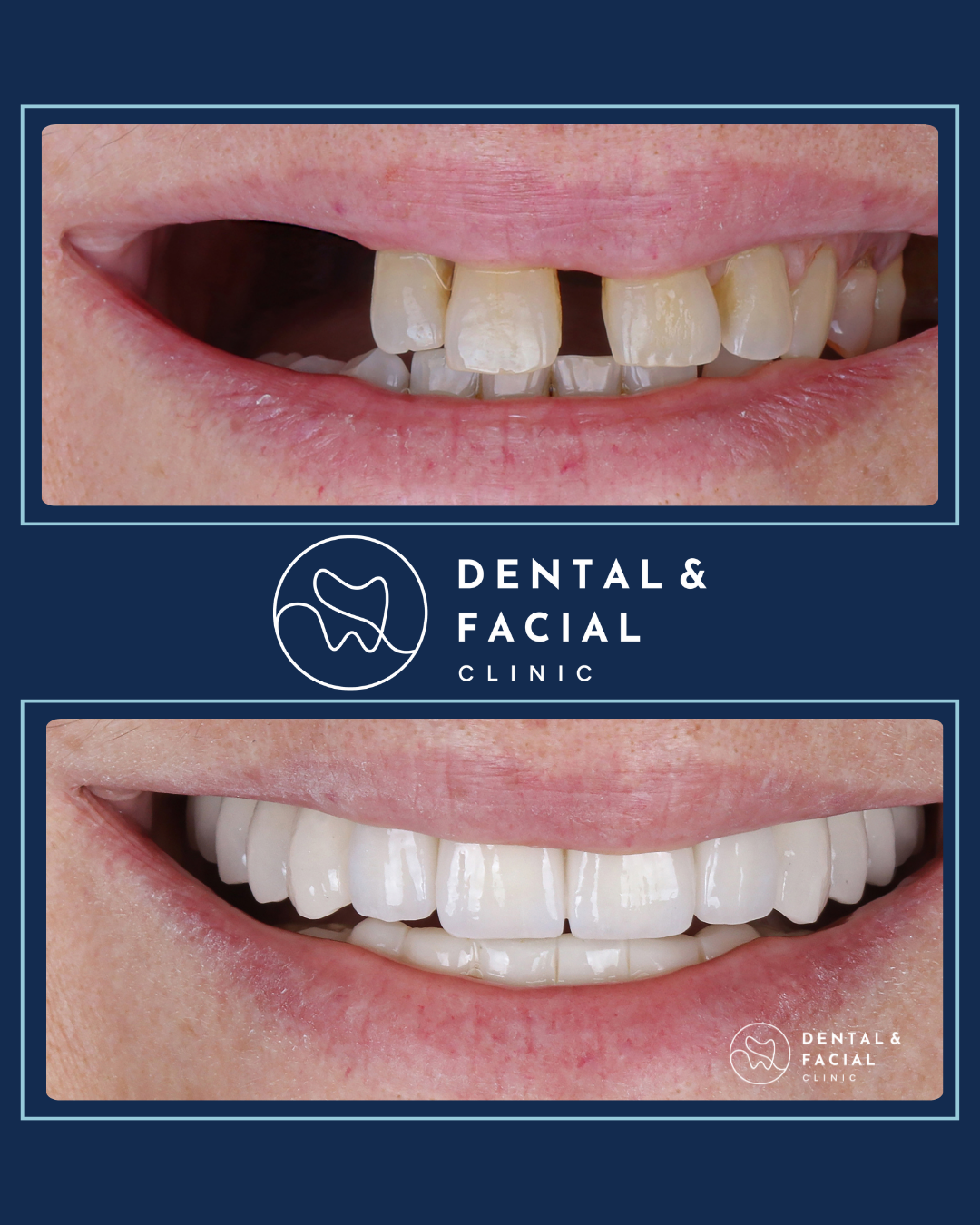 Teeth Implants 21 3