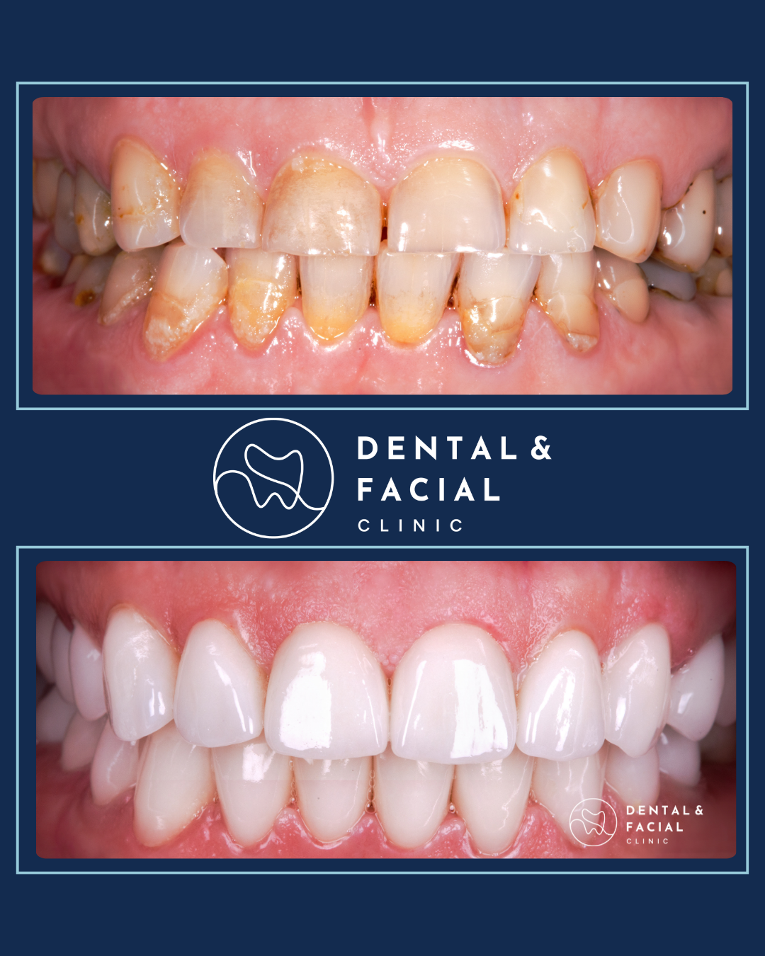 Composite Veneers 22 4