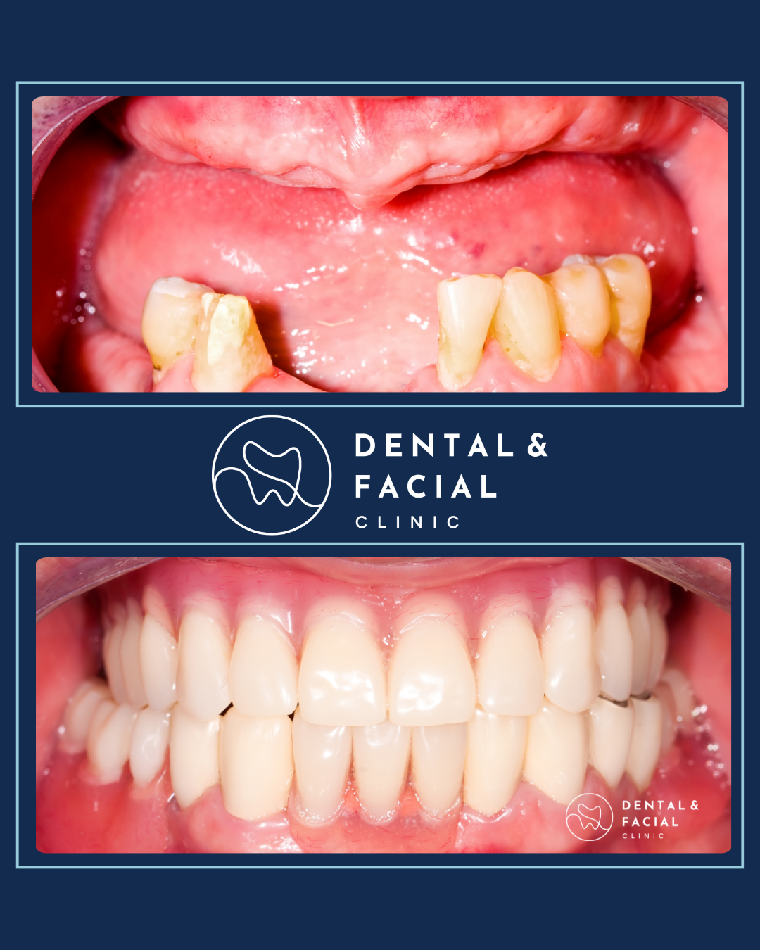 Teeth Implants 22 4