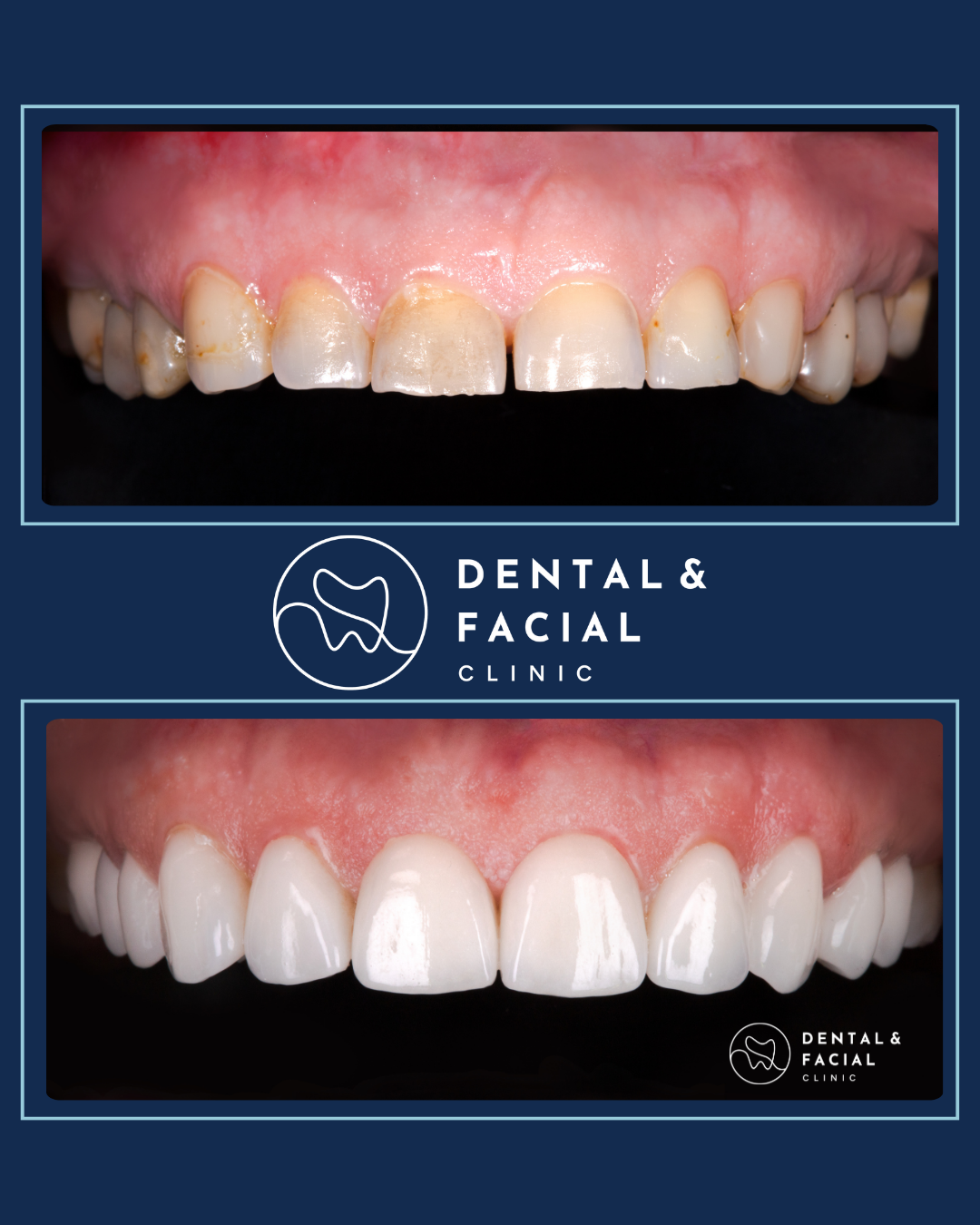 Composite Veneers 23 5