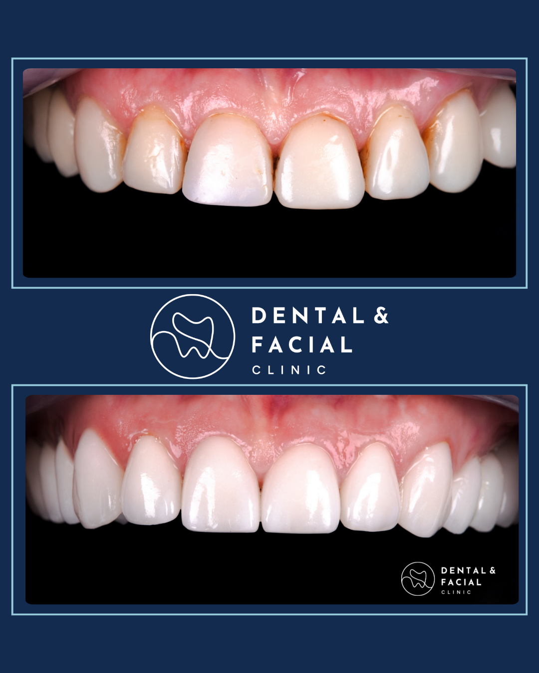 Composite Veneers 24 6