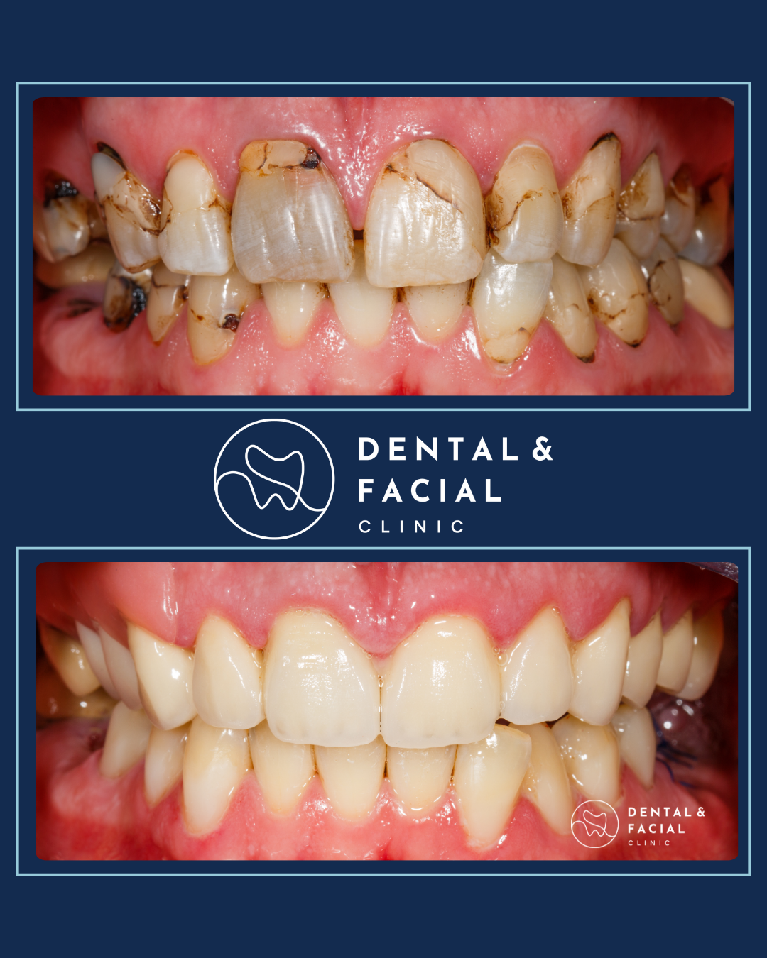 Teeth Implants 23 6