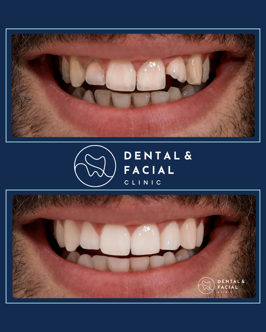 Composite Veneers 25 7