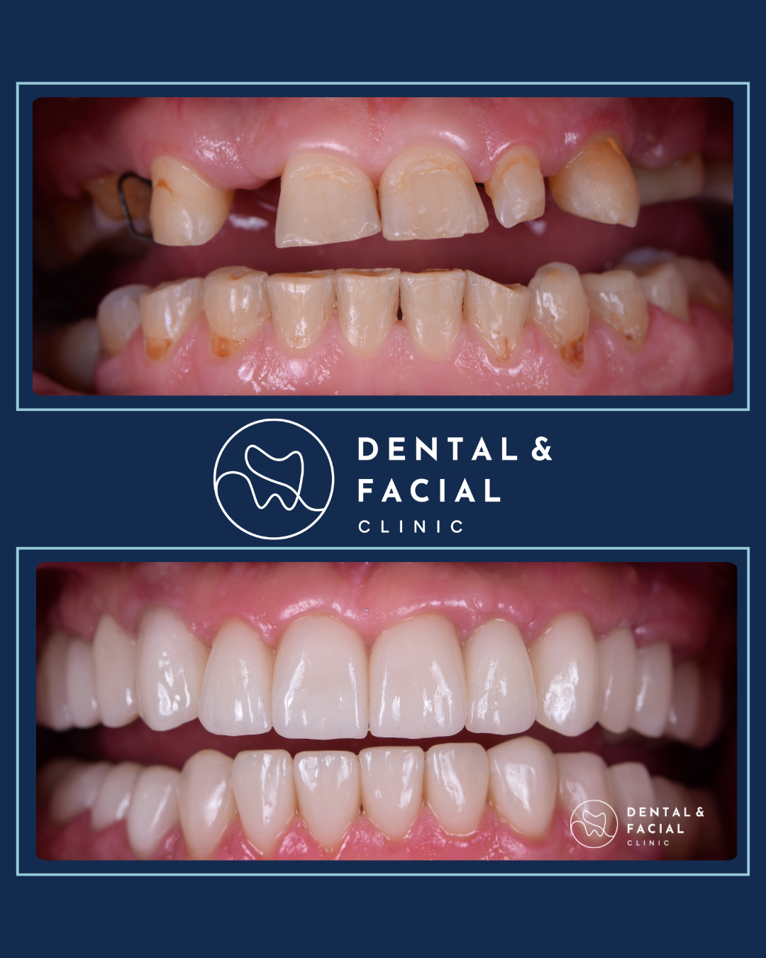 Teeth Implants 24 7