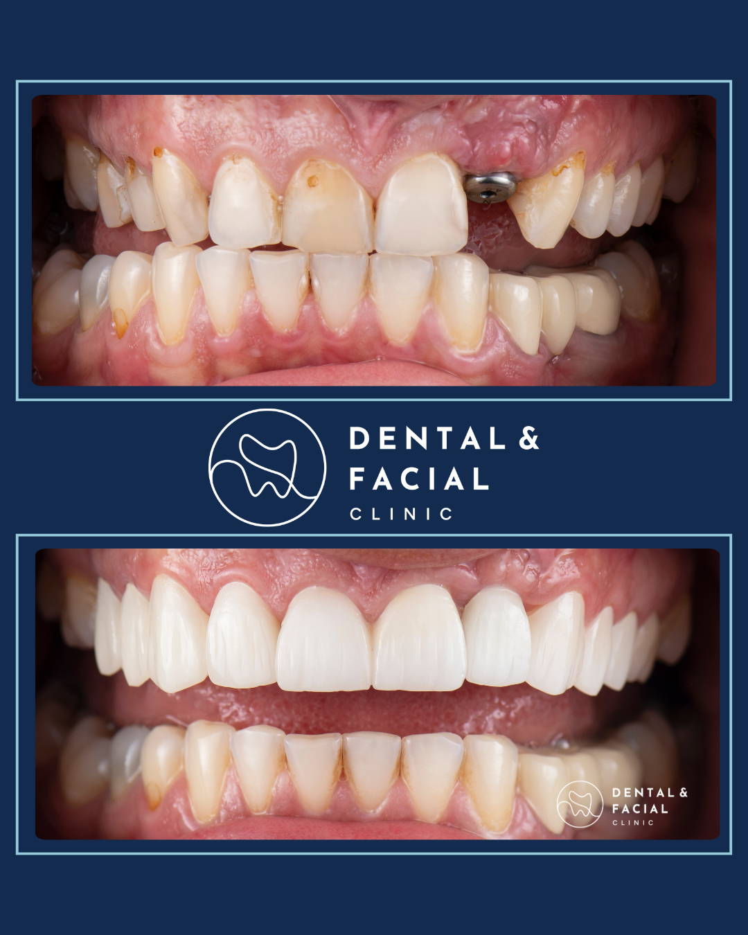 Teeth Implants 25 8