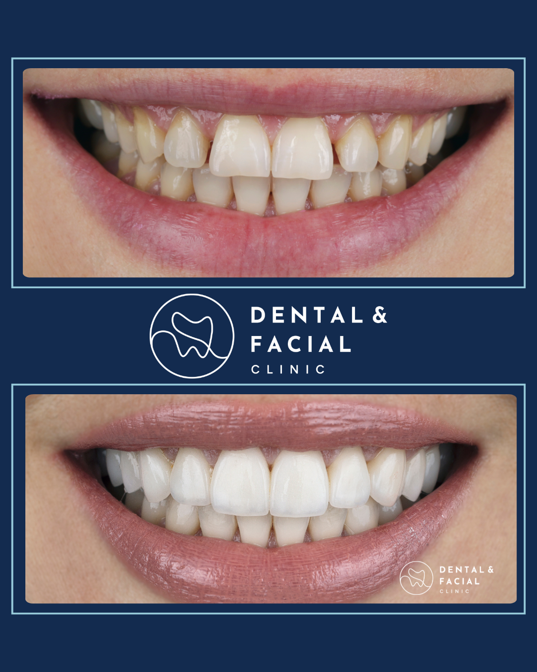Composite Veneers 26 9