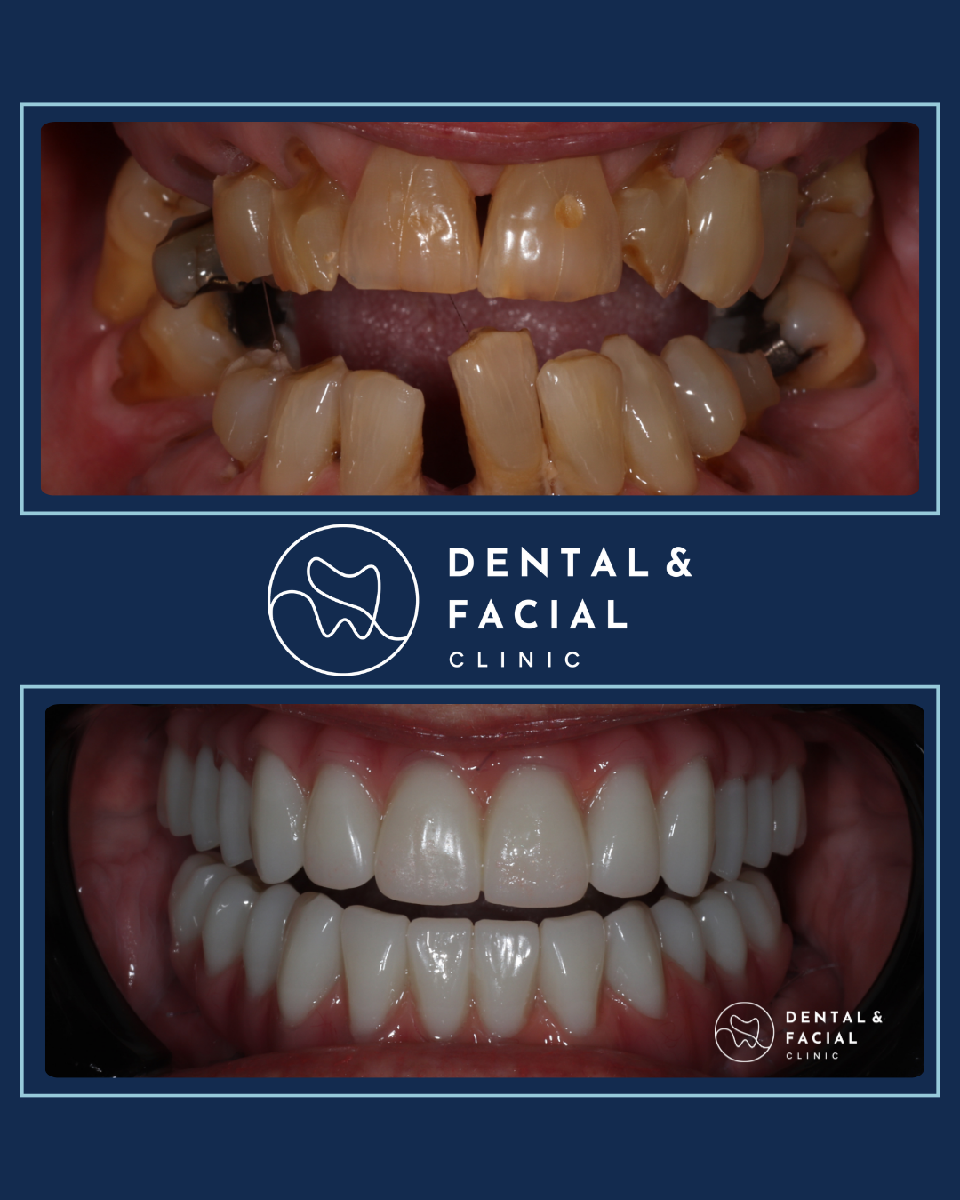 Teeth Implants 26 9