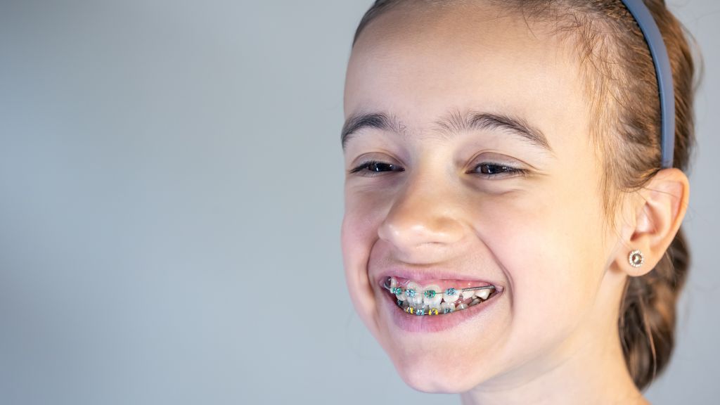 How Do Palatal Expanders Work Alongside Braces for Kids? 2 Braces for Kids