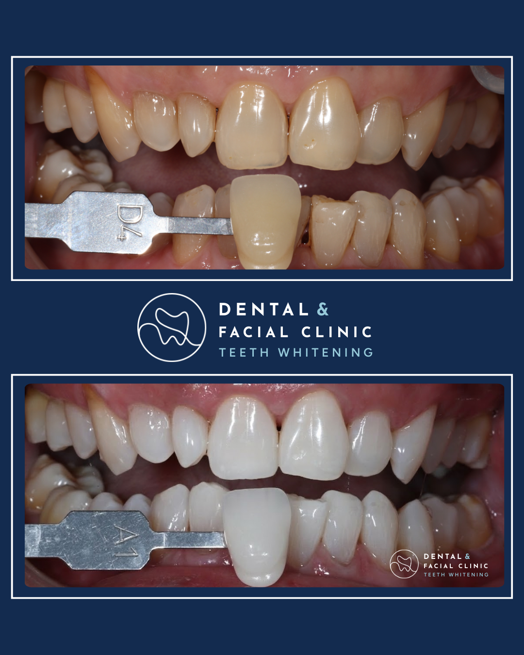 Teeth whitening