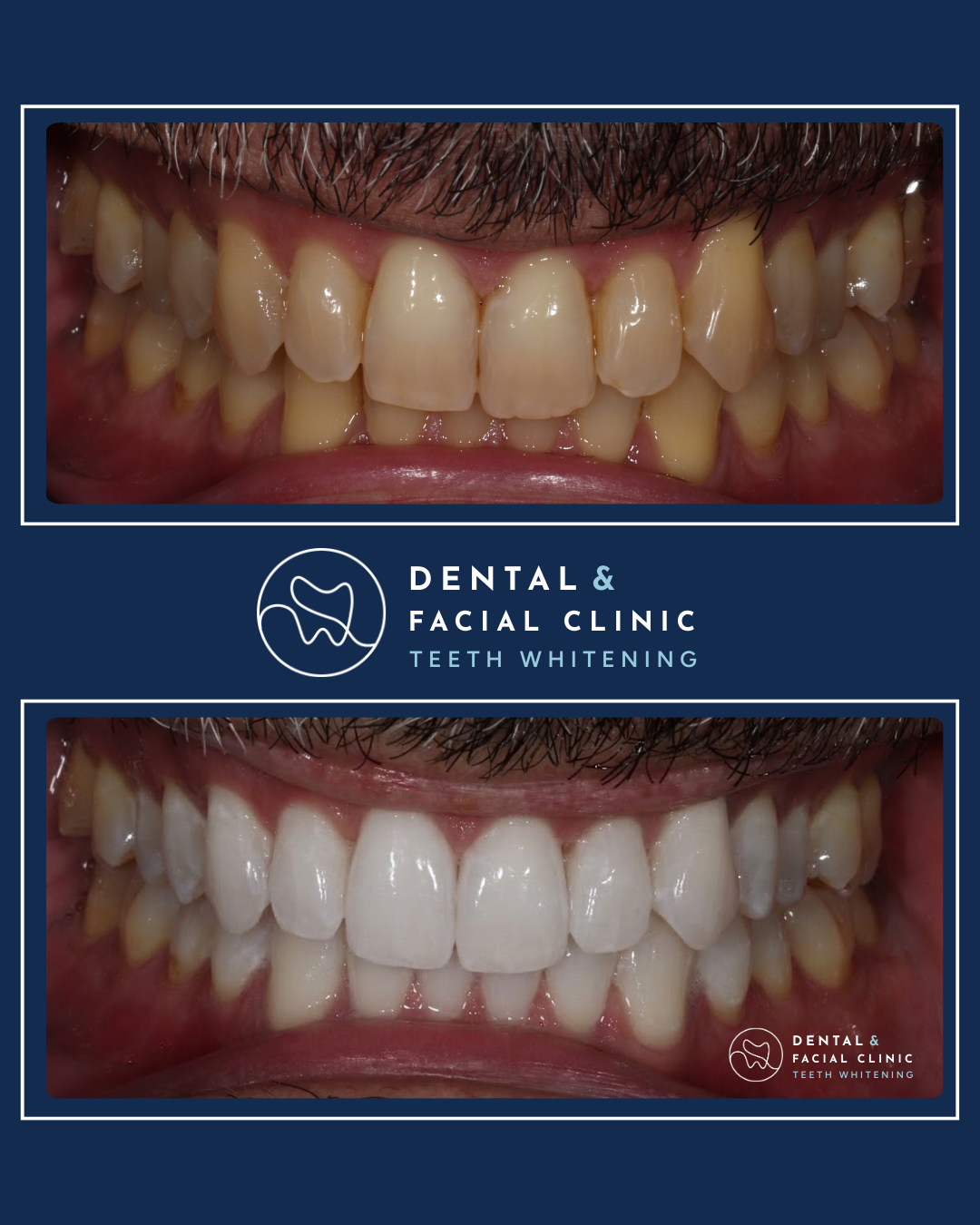 Treatment: WHITENING
Approximate Treatment Time: Same Day