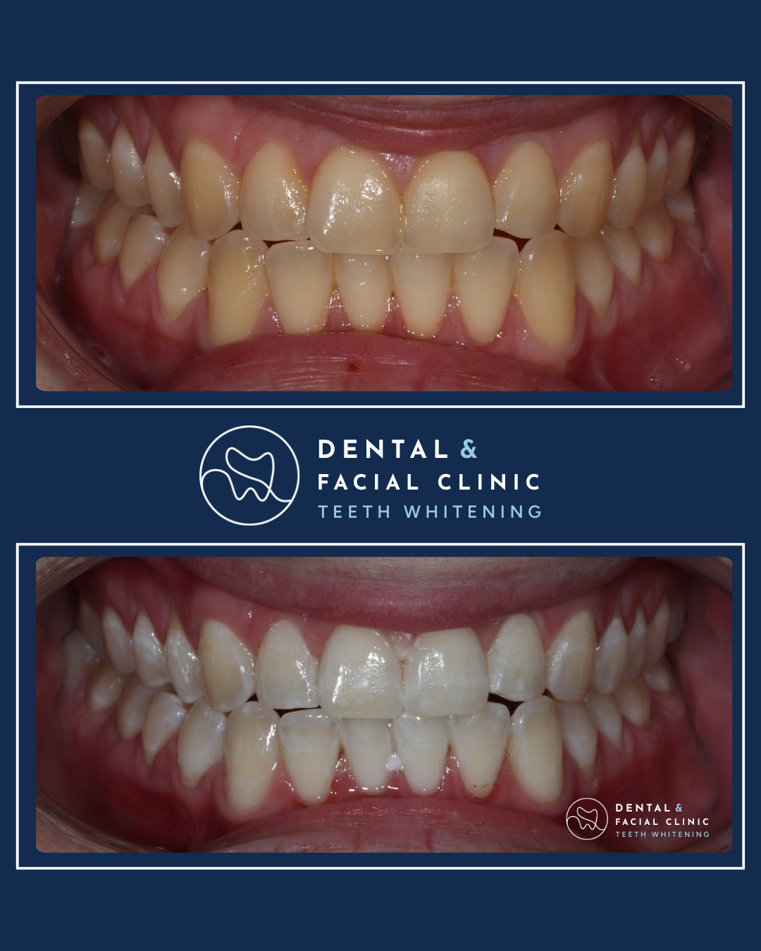 Treatment: WHITENING + CROWN
Approximate Treatment Time: 4 weeks