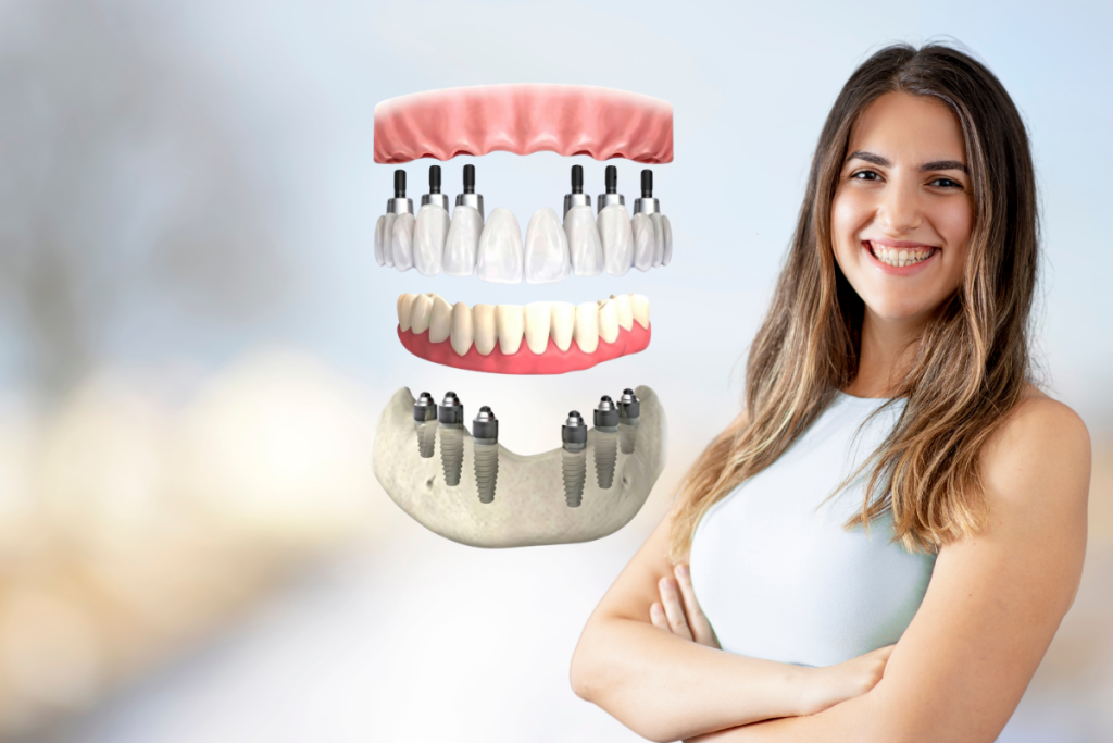 All on X® Dental Implants banner 1