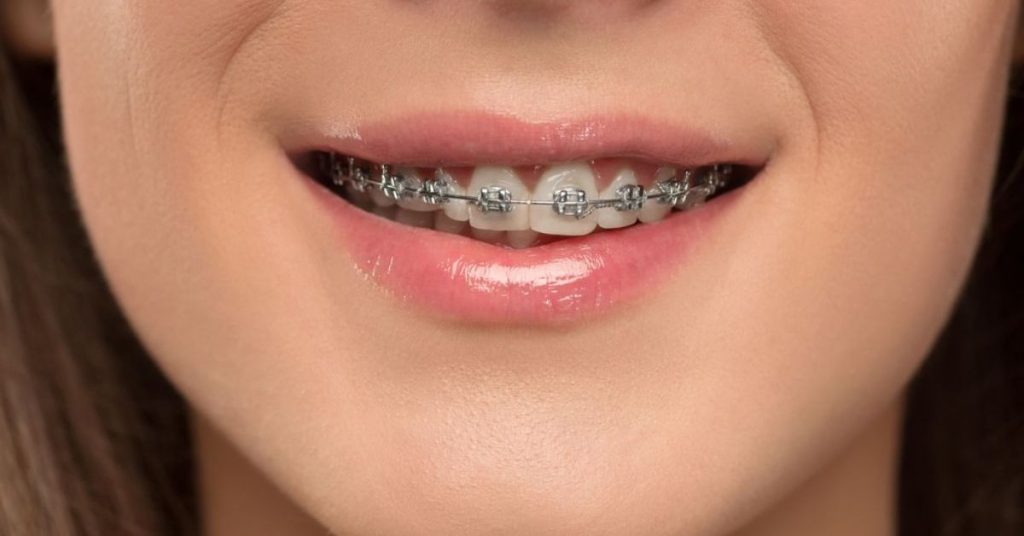 Education 20 Braces