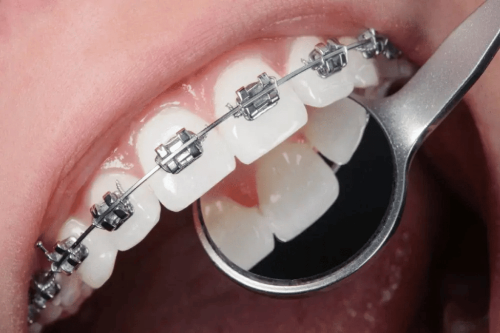 Special Offers New 2 9 Free Orthodontics Consultation