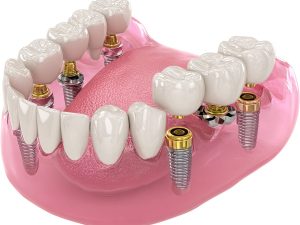 All-on-6 implants