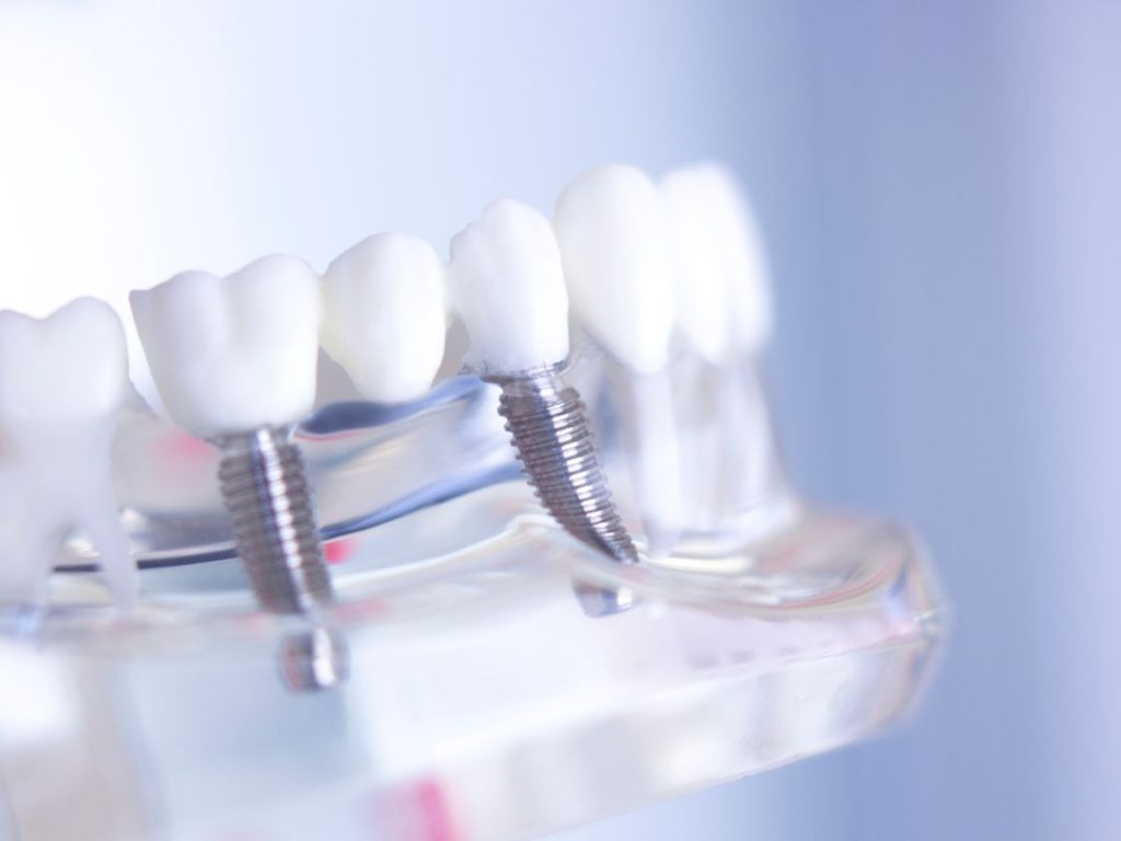 How do multiple teeth implants restore chewing