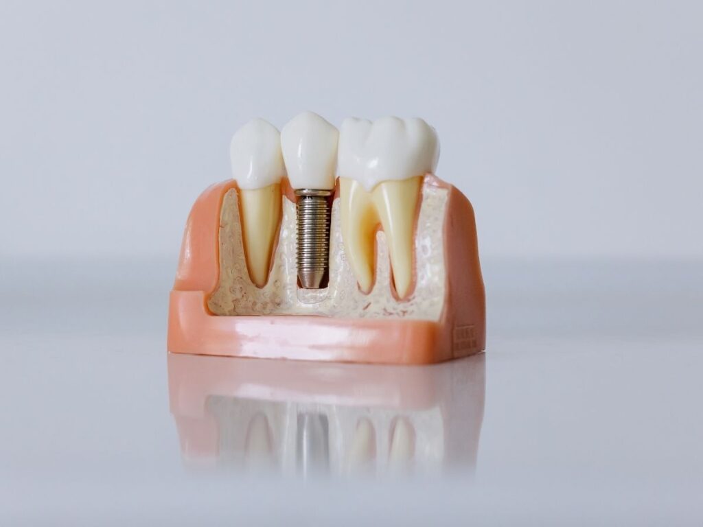Homepage 54 Dental Implants