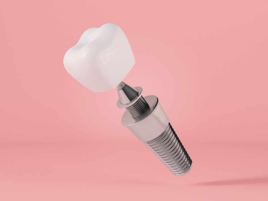 Who Is a Good Candidate for a Single Tooth Implant? 4 Single Tooth Implant