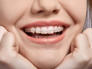 Ceramic Braces